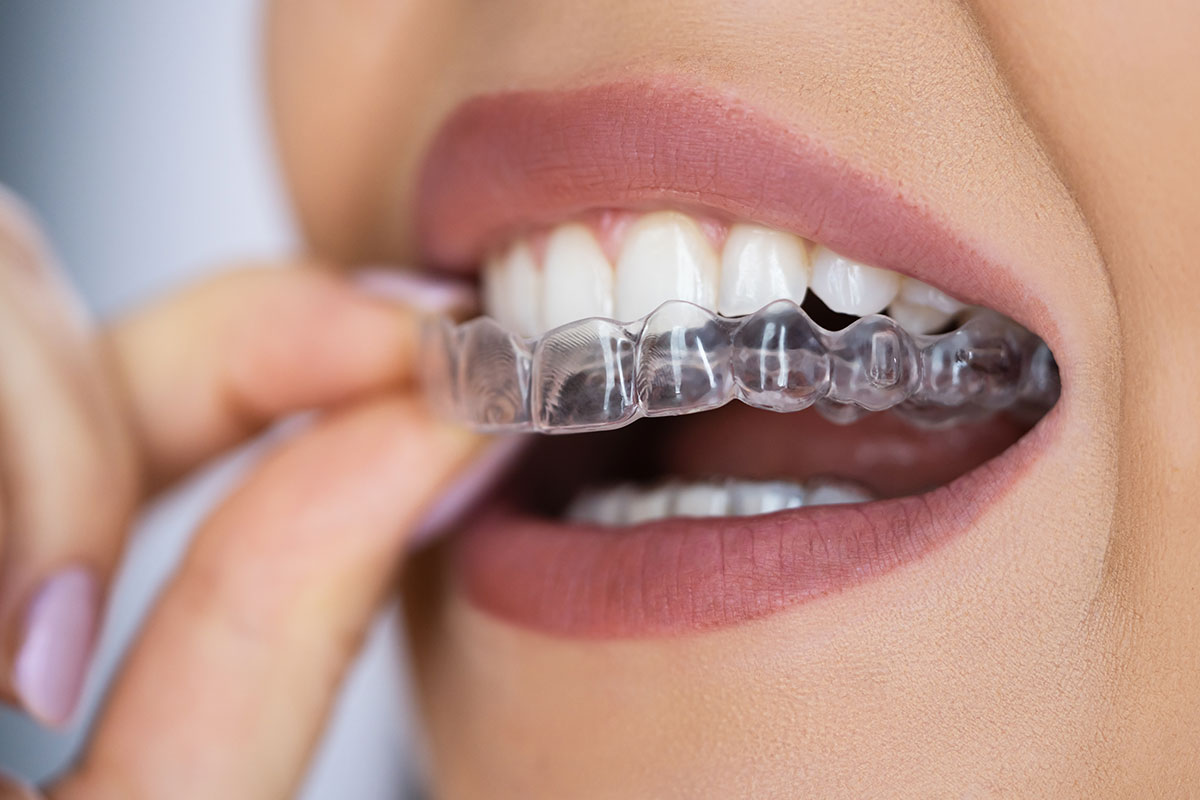 Die Knirscherschiene hilft gegen Zähneknirschen